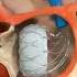 Altavalve Transcatheter Mitral Valve Replacement TMVR Shorts Medical Animation