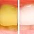 How To Whiten Your Teeth