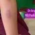 Mantoux Test Is This Test Positive Shorts