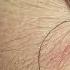 Learn How To Suture Best Suture Techniques And Training