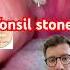 Removing Tonsil Stones Shorts