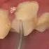 Getting A Teeth Cleaning After 5 Years Teethcleaning Tartarremoval Plaque Tartar