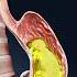 What Happens In Your Body When You VOMIT Explained In 3D