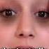 Do This To Remove Eye Bags Instantly