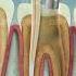 Root Canal Treatment Curveia Dental I RCT