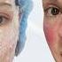 CO2 Fractional Laser Treatment In Thailand Day By Day Recovery Wks 1 3