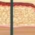 Needle VS Needle Free Injection