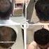 Best Hair Transplant Results Pre And Post Hair Transplant At Adorn Aesthetic Clinic Ahmedabad