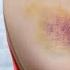 What Causes Bruises On Legs Arms Top 5 Causes Of Bruising Covered By Dr Berg