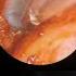 What Happens When You Remove A Giant Ear Wax Plug