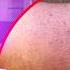 19 Signs Of HYPERTHYROIDISM Graves Disease You Can See Doctor Explains