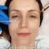 Linerase Skin Booster Beverly Wilshire Damansara PJ Theyumlist Skinbooster Aesthetictreatments