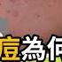 為什麼成人痘很難治療 男生會長成人痘嗎 皮膚科醫師指出 忽略這4點 治療效果就不好
