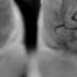 Living With Bound Feet