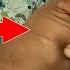 Live Terapis Jalanan Mbah Juned Bantu Penderita Stroke