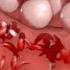 Sickle Cell Anemia