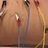 Dryneedling With Estim For Sciaticpain