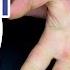 Allen Test Hand Vascularisation