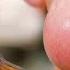 Squeezing Out A Swollen Jaw Lump Dr Pimple Popper A Pimple Carol