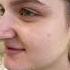 6 Months After Designer Rhinoplasty Nosejob Bestnosejob Rhinoplastysurgeon Nycplasticsurgeon