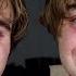 Identical Twins With Identical Disabilities Surviving Twin To Twin Transfusion