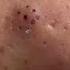 Popping Huge Blackheads And Giant Pimples Best Pimple Popping Videos 182