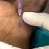 ABG Technique Radial Artery Norcet Nursing Knowledge Medical Abg