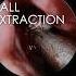 FUNGUS BALL EXTRACTION Breathebetter Sinusitis Fungus Snot Entsurgeon Allergies Surgery