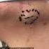 Go Watch A Flowing River Cyst On YT For The Full Procedure Including The Sac Extraction