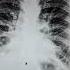 X Ray Chest Pa View Fractured Ribfracture Foryou Viralvideo Vira