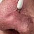 Let S Get That Thing Out Dr Derm
