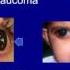 UP Med Webinars Glaucoma Sneak Thief Of Sight