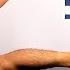 Ely S Test Rectus Femoris Contracture