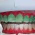Laser Teeth Whitening Before And After Shorts Teethwhitening Dentist Beforeafter