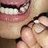 Di Na Kailangan Ng Dentist Shortsfeed Teeth Tooth Sweettooth Dentist Fyp Bunot Alternative