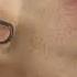 Carbon Laser Treatment For Skin Rejuvenation Shorts Lasertreatment