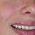 I Got NEW TEETH La Vlog Disneyland