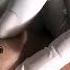 Warts Removal Treatment Safe And Effective Wart Removal Treatment Skinaa Clinic Viral Ytshorts