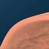 What Causes GERD