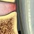 Epidural Steroid Injections