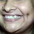Trying Fake Dimple Hack Get Dimple In 2 Minutes Shorts Trend Dimplehack