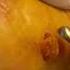 Watch This Plantar Wart Removal Surgery A Satisfying Procedure For Foot Enthusiasts