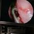 Removing A Sinus Fungus Ball From A Patient S Nose Nose Allergy Allergies Snot