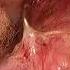 Laparoscopic Pectopexy By Dr Amit T