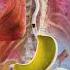 Acid Reflux Explained
