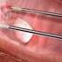Removing A Polyp From Your Uterus 3D Animation