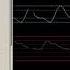Philips IntelliVue Patient Monitoring Basic Operation