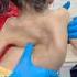 Scoliosis Treatment By RKM Rkm Chiropractor Drrajneeshkant Painfreeindia