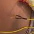 Dry Needling With Electrical Stim For Chronic Back And Hip Pain In A Professional Athlete