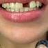 Making A FRONT TOOTH DENTURE Shorts Denture Missingtooth Youtubeshorts Teethbits Shortsfeed